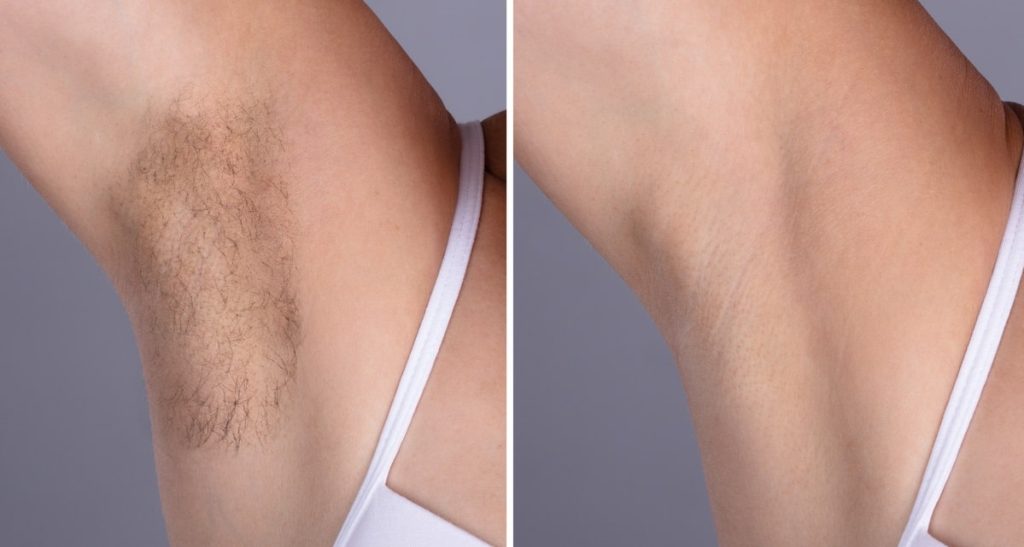 Epilation laser VS épilation définitive par électrolyse