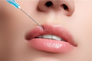 Techniques innovantes des injections des lèvres